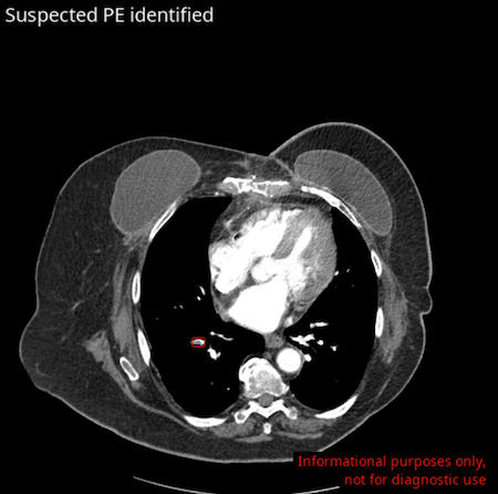 AI based PE Detection